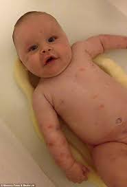 Blood in the urine, pain or burning upon urination; Baby With Blueberry Muffin Syndrome Is Diagnosed With Leukaemia Daily Mail Online