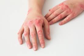 Image result for dermatitis contacta