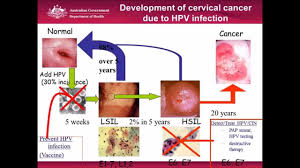 During a pap test, the doctor takes a sample of cells from the surface of the cervix. Cervical Cancer Screening Is This The End Of The Pap Smear Youtube