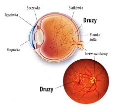 1 uproszczony schemat budowy siatkówki oka. Co To Jest Plamka Zolta Zwyrodnienie Plamki Zoltej Nowa Metoda Laser 2rt