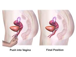 A vaginal ring, going by its trade name nuvaring, is one of the many contraceptive options available to women. File Vaginal Ring Application Steps 2 3 Png Wikipedia