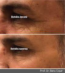 goz cevresinde derin kirisikliklar icin oncelikle botoks uygulanmali sonrasinda ise goz cevresine ozel yaslanma karsiti kremle okuma yaslanma gunluk bakim