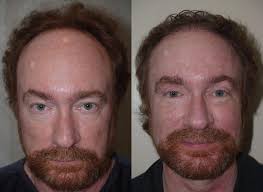 Jerry kennard, phd, is a psychologist and associate fellow of the british psychological society. Men S Plastic Surgery Miami Fl Patient 19574