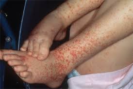 Image result for Vasculitis
