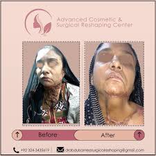 Advanced Cosmetic and Surgical Reshaping Center (@dr.abdulsamee) •  Instagram photos and videos