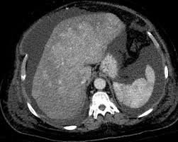 Liver Atlas Diagnosis Budd Chiari Syndrome