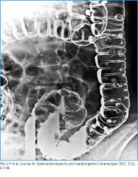 Surgical management of locally advanced and locally recurrent colon cancer. Abbildung 3 Kolonkontrasteinlauf Mit Darstellung Der Divertikel Im Colon Sigmoideum Und Ascendens