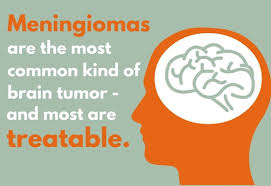 Meningioma Treatment Johns Hopkins Medicine