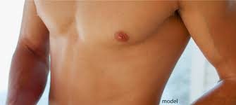 Gynecomastia Surgery Recovery Tips Timeline What To Expect