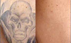 Check spelling or type a new query. Picosure Tattoo Removal Anna Avaliani Md Cosmetic Laser Surgery Anna Avaliani Md Cosmetic Laser Surgery