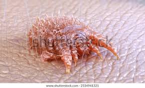 Image result for what does scabie look like