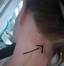 Durch vorausgegangene infektionskrankheiten, wie z.b. Ist Dort Ein Lymphknoten Und Wenn Nicht Was Kann Dort Sonst Anschwellen Medizin Angeschwollen