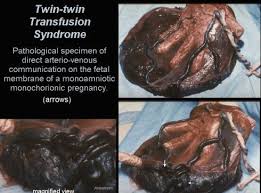 Twin Twin Transfusion Syndrome Tts