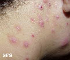 Image result for Neurotic Excoriation