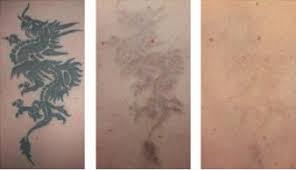 If you live in beaverton, tigard, hillsboro, lake oswego, west linn, wilsonville, oregon city, newberg, vancouver, or any other portland area, we are your tattoo removal specialists. Distributor Laser Hair Removal Tattoo Removal S600 China Laser Tattoo Removal Clinic Laser Made In China Com