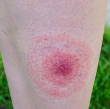 Image result for mosquito bite