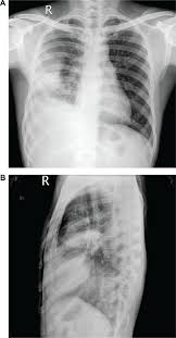 Larger volume aspiration to relieve symptoms of dyspnoea. Pleural Effusion Diagnosis Treatment And Management Abstract Europe Pmc