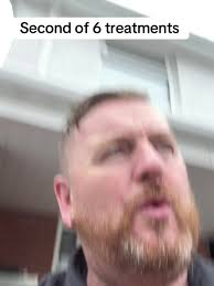 Paddy's Hair Restoration Journey in Belfast