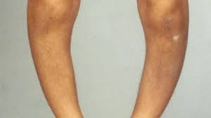 Check spelling or type a new query. 12 Macam Macam Penyakit Tulang Yang Harus Diwaspadai Hot Liputan6 Com