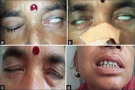 Check spelling or type a new query. Guillain Barre Syndrome Presenting As Bell S Palsy With Crossed Hemiparesis Abstract Europe Pmc
