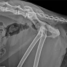 Anatomy of ilioinguinal and iliohypogastric nerves in relation to trocar placement and low transverse incisions. Imaging Anatomy