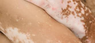 Image result for diaper dermatitis adult -children -infant -baby