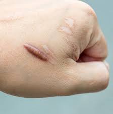 How To Get Rid Of Scars - Dermatologist Tips On How To Remove Old Scars