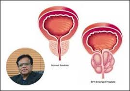 Urinary Obstruction A Disease Of Elderly Men