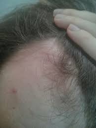 But minoxidil has less side effects, and it's a proven hair loss treatment that may help extend your hair's lifespan. What Happens If I Stop Using Minoxidil After 1 Month Photos