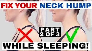 Over time, this change in bony alignment can even compromise the function of the organs, including negative effects on the circulatory system. Neck Hump Fix Chiropractic On Eagle Dr Jon Saunders