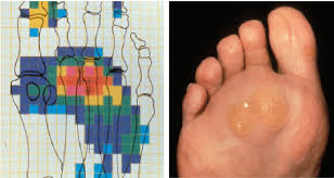 Pertinent Insights On Lesser Metatarsal Osteotomies