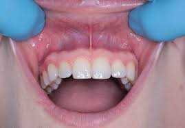 Image result for dental cancer