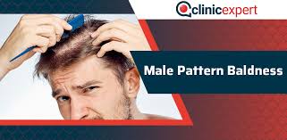 This is due to a shrinkage in hair follicles caused by hormonal changes as you grow older. Male Pattern Baldness Clinicexpert International Hair Transplant Plastic Surgery