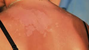 I Can Treat Sunburn With That Unusual Items That Will Help Soothe The Pain