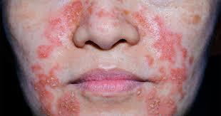 Eczema is a condition that causes inflamed, itchy, cracked, and rough skin. Seborrhoisches Ekzem Ursachen Symptome Behandlung Kanyo