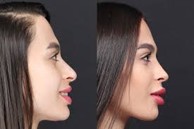 Rhinoplasty