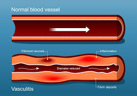 Image result for Vasculitis