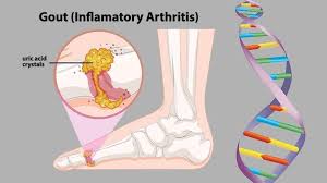 See full list on draxe.com Genetics Not Diet Is The Likely Cause Of Gout Everyday Health