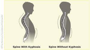 It's a sensibly put together library full of tools to help you organise. Kyphosis For Teens Nemours Kidshealth