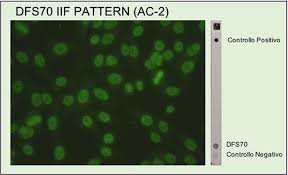 Image result for ANA Staining Pattern