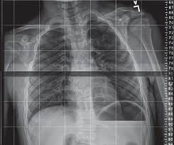 It is found just under the right rib cage. Fusion Of The Posterior Aspect Of The 3rd And 4th Right Ribs Download Scientific Diagram