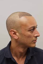 Emmerdale's Chris Bisson reveals he's had a hair transplant to retain his  good looks and protect his career