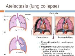 Atelectasis Nursing School Life Pediatric Nurse Practitioner Pediatric Nursing