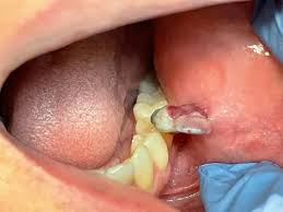 Image result for dental cancer