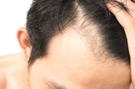 Triggers differ from person to person. Hair Loss Causes And Treatments Royal Tunbridge Wells Uk