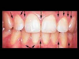 It should be used only one time in week. Can Receding Gums Grow Back Youtube