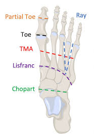 Image result for toe amputation
