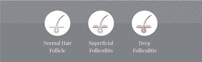 Image result for Deep Folliculitis