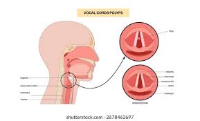 Image result for Hoarseness