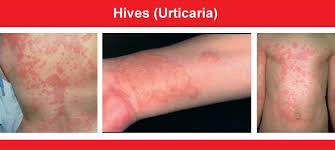 Image result for Hives